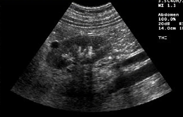 Grayscale ultrasound image of a kidney